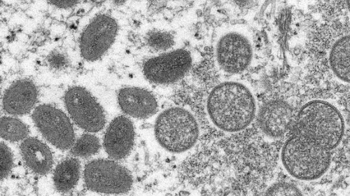 Estado de SP monitora paciente com suspeita de varíola dos macacos; Brasil tem 7 casos em investigação, diz ministério