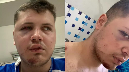 Após acidente de moto, jovem corre contra o tempo para fazer cirurgia de R$ 20 mil e evitar que rosto fique desfigurado