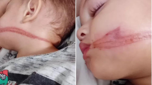 Bebês gêmeos são atingidos no rosto por  chicotada  de fiação solta em rua no interior de SP